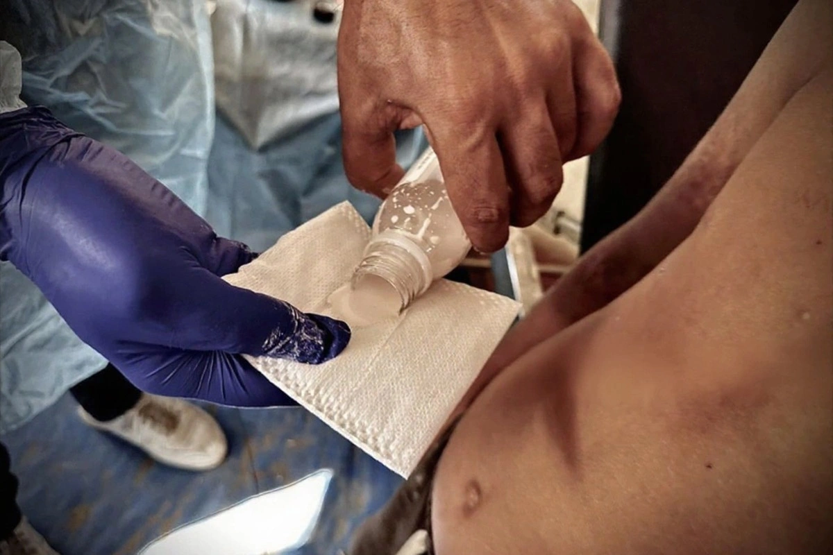 نمک برای انگل گال