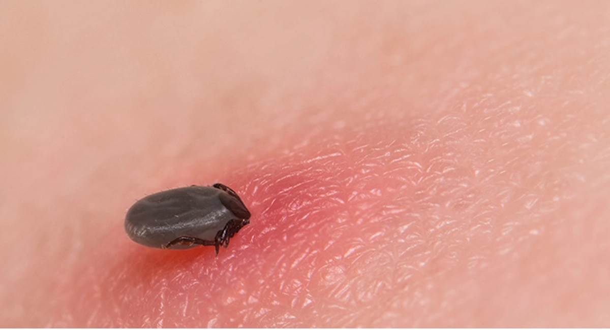 از کجا بفهمیم چه حشره ای ما را نبش می زدم